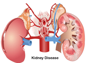 WHY KIDNEY FAILS ? Some Common Causes | Kidney failure treatment