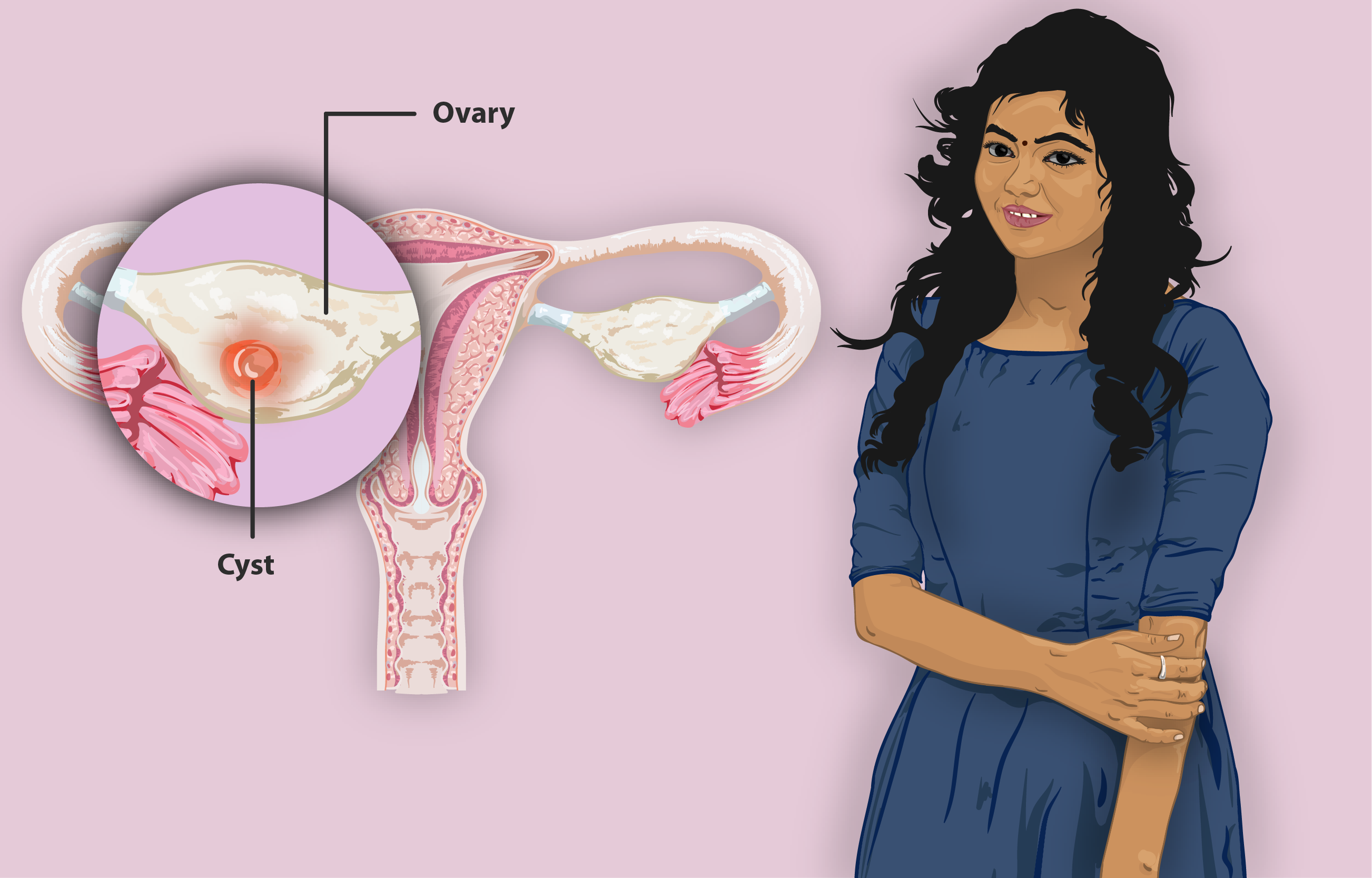 Ovarian Cyst And Its Homeopathic Treatment Kidney Failed